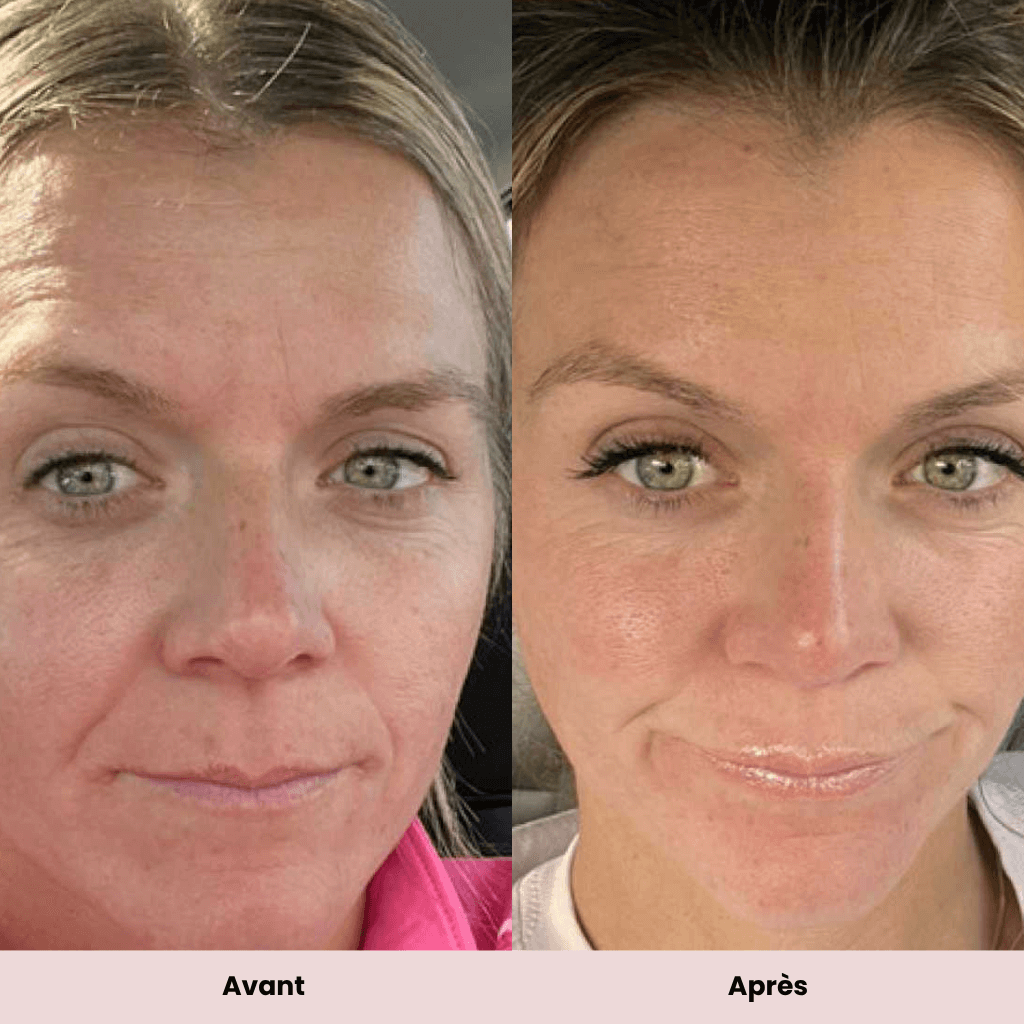 Anne S. 33 ans – témoignage luminothérapie LED teint éclatant et rides réduites