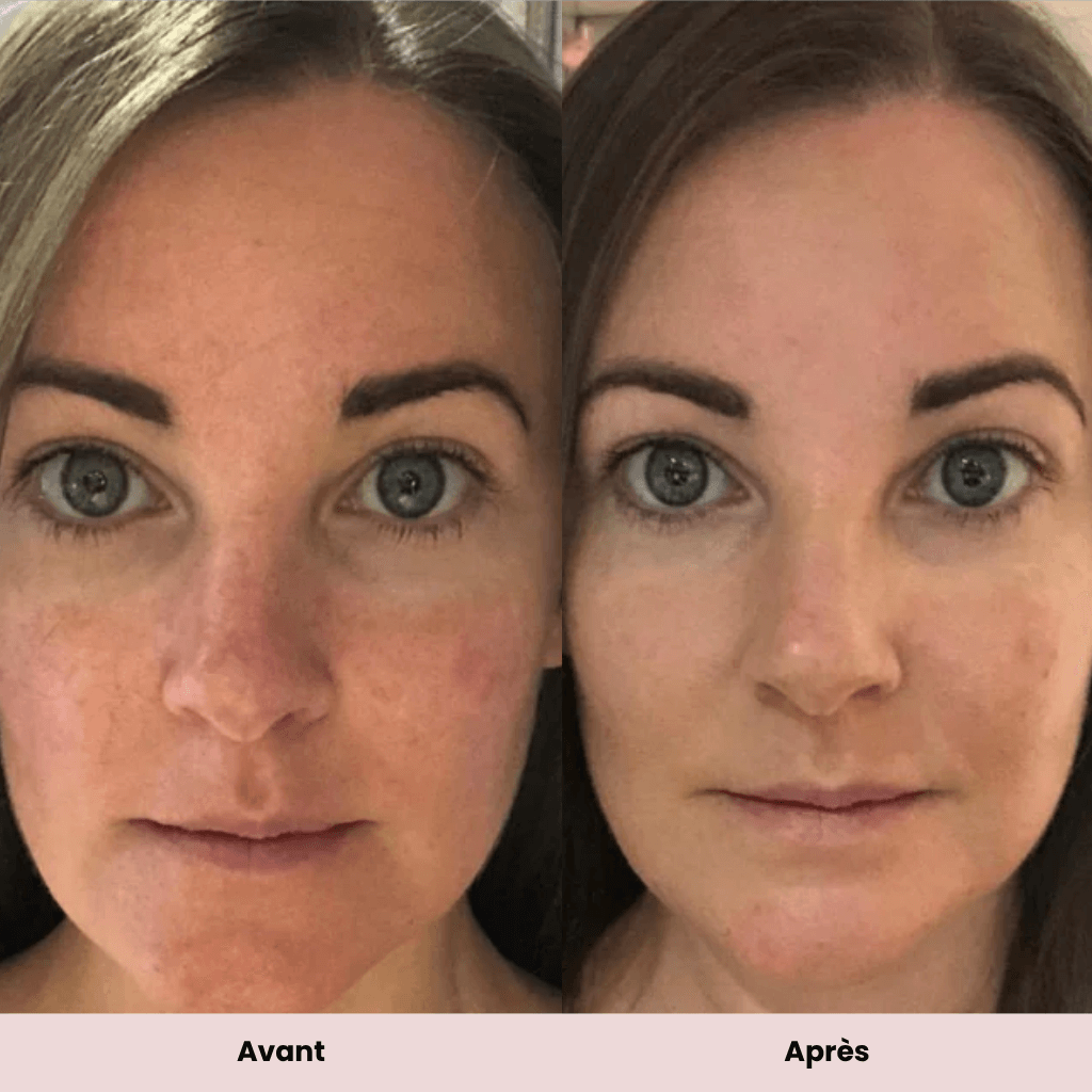 Sophie P. 49 ans – avis masque LED anti-âge CleanSkeen rides et rougeurs
